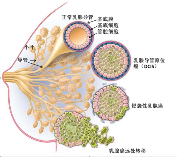 特别奉送系列之182什么是乳腺导管原位癌